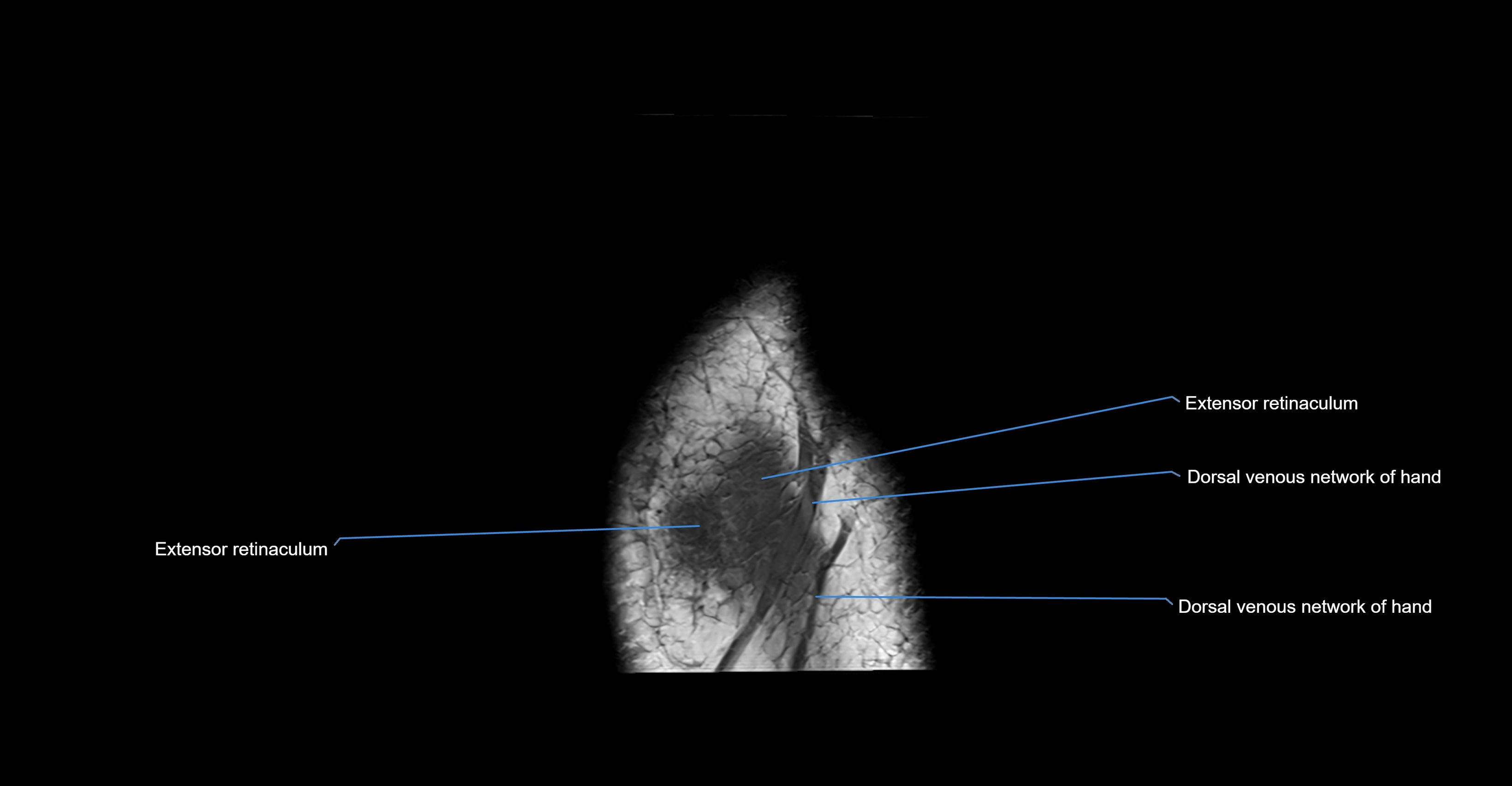 MRI wrist coronal cross sectional anatomy 3T  radiology  image-img-00001-00005.webp